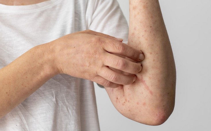 Epidemia por Mpox dejó de ser emergencia sanitaria global Epidemia por Mpox dejó de ser emergencia sanitaria global